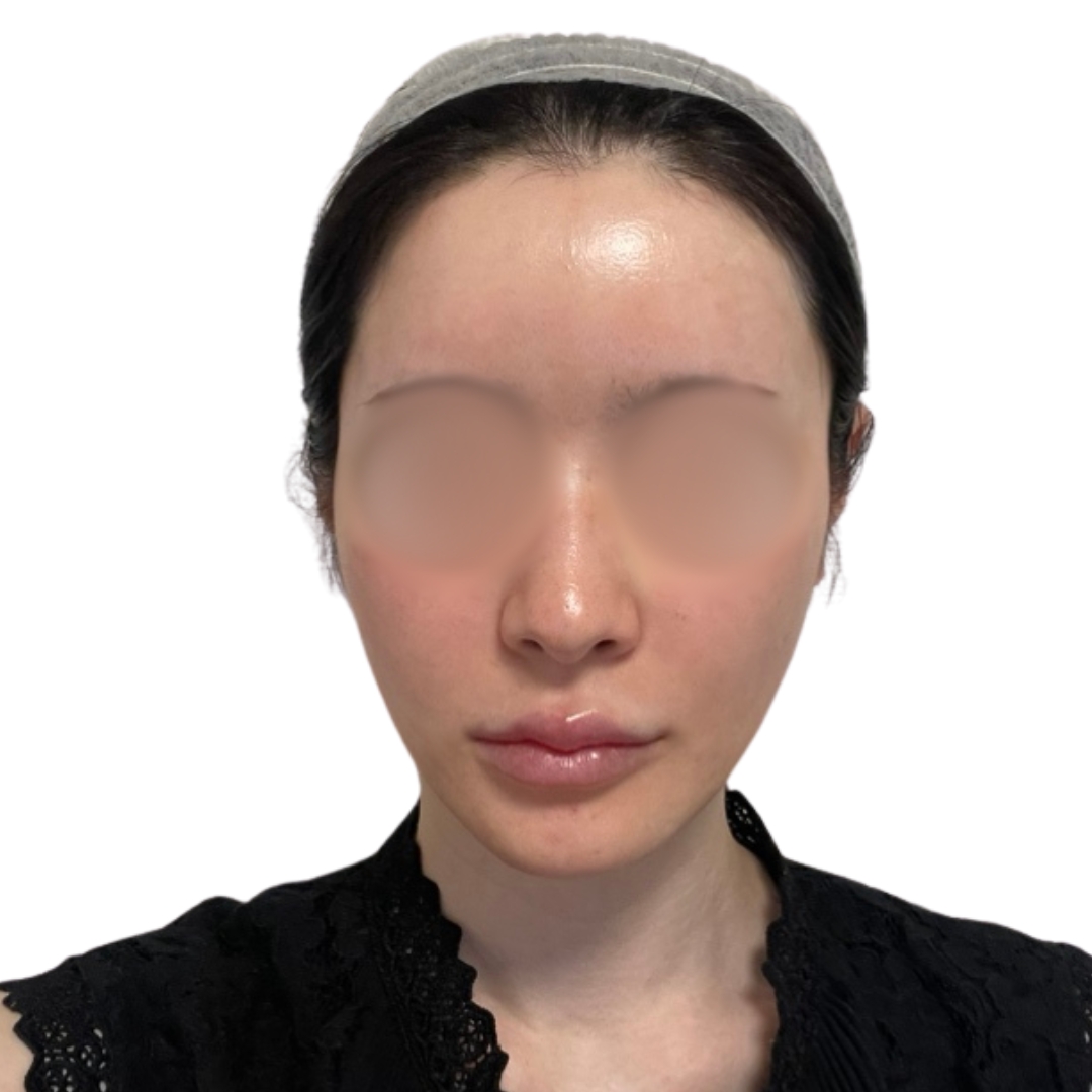 エクソソームフェイシャル